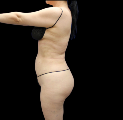 Brazilian Butt Lift: Case 22 - After