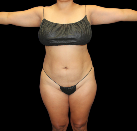 Brazilian Butt Lift: Case 23 - Before