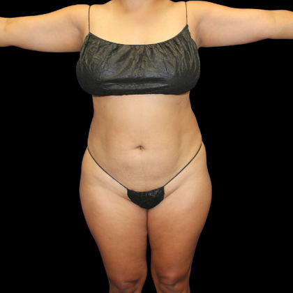 Brazilian Butt Lift: BBL 14 - Before