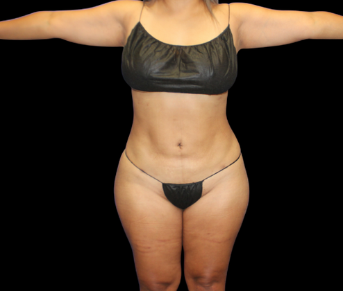 Brazilian Butt Lift: Case 23 - After