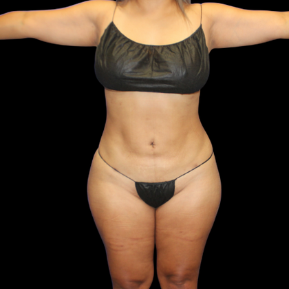 Brazilian Butt Lift: BBL 14 - After