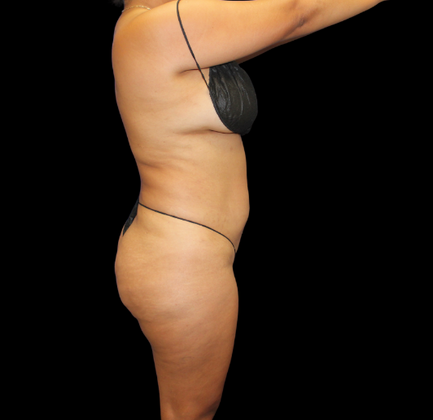 Brazilian Butt Lift: Case 23 - After