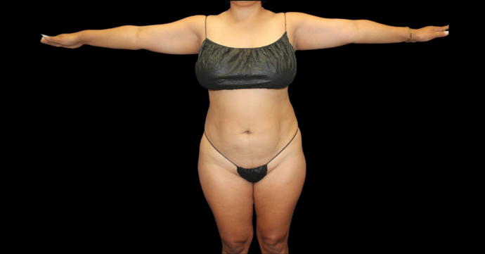 Liposuction: Case 15 - Before