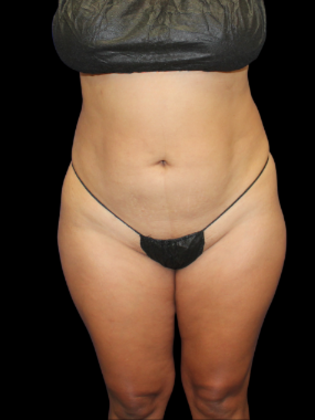 Liposuction Liposuction 5 - Before