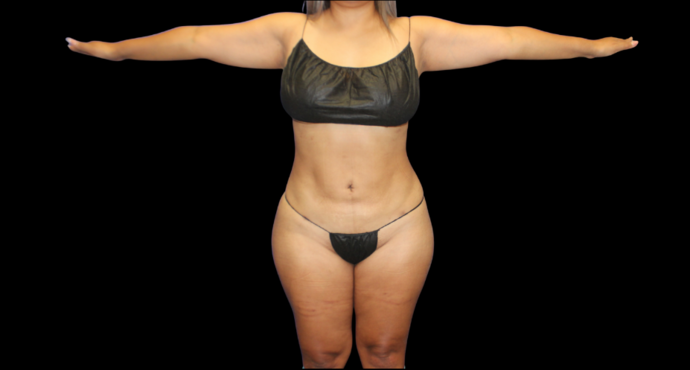 Liposuction: Case 15 - After