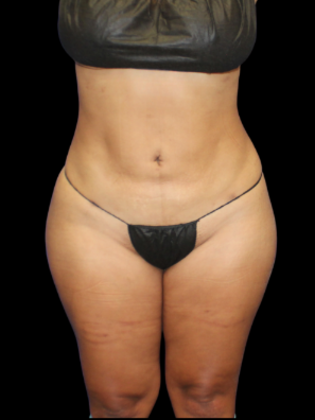Liposuction Liposuction 5 - After