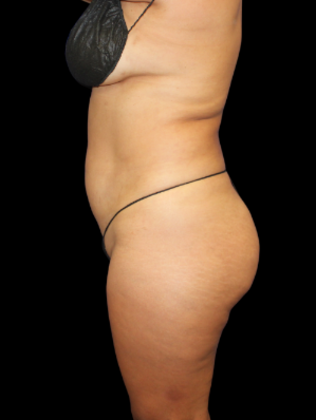 Liposuction: Liposuction 5 - Before