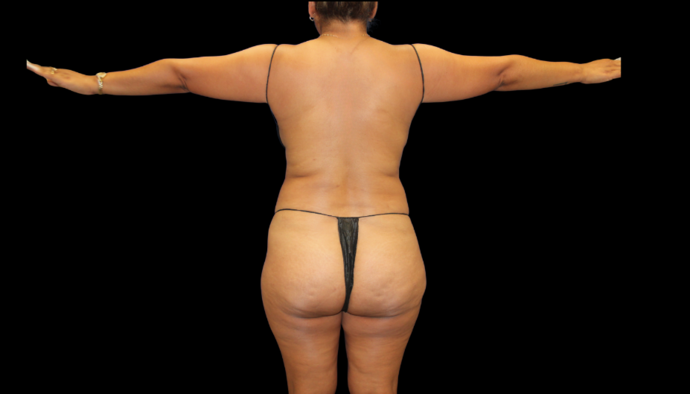 Liposuction: Case 15 - Before