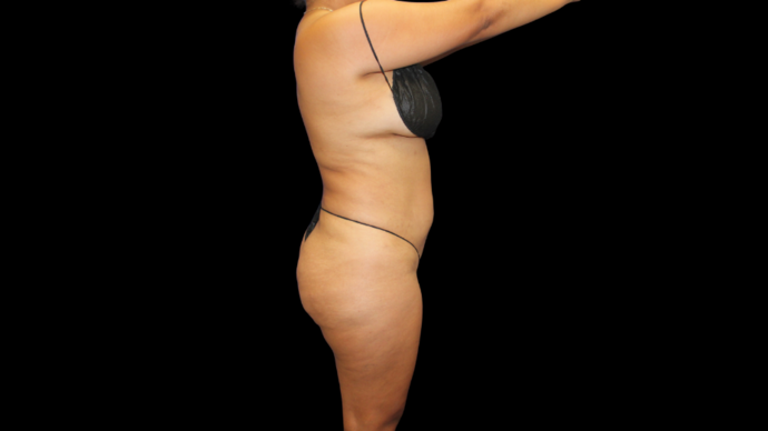 Liposuction: Case 15 - Before