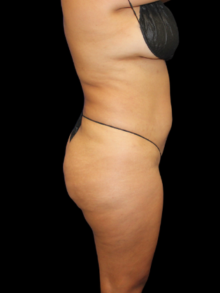 Liposuction: Liposuction 5 - Before
