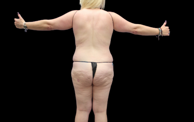 Liposuction: Case 16 - Before