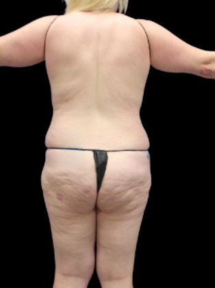 Liposuction: Liposuction 16 - Before