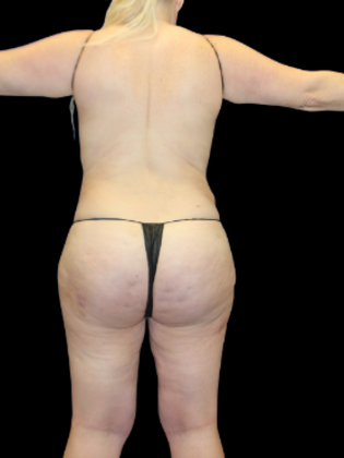 Liposuction: Liposuction 16 - After