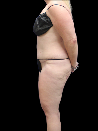 Liposuction Case 16 - Before