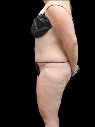 Liposuction: Liposuction 16 - Before