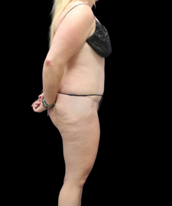 Liposuction: Case 16 - After