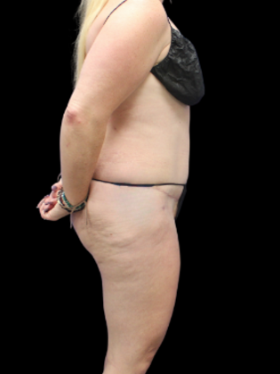 Liposuction: Liposuction 16 - After