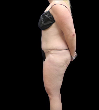 Brazilian Butt Lift: Case 24 - Before