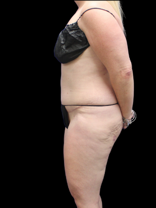 Brazilian Butt Lift: BBL 17 - Before