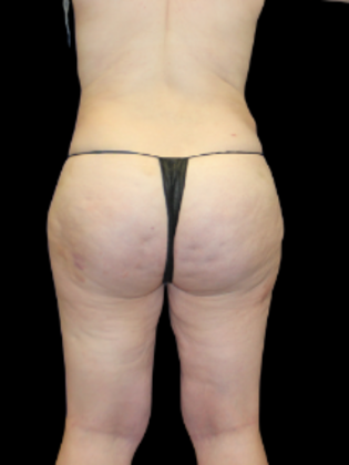 Brazilian Butt Lift BBL 17 - After