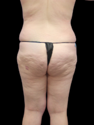 Brazilian Butt Lift BBL 17 - Before