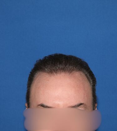 Hair Transplants: Case 12: FUE Hair Transplant to Rebuild the Hairline and Mid-Scalp - After
