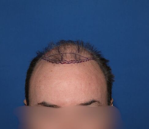 Hair Transplants: Case 12: FUE Hair Transplant to Rebuild the Hairline and Mid-Scalp - Before