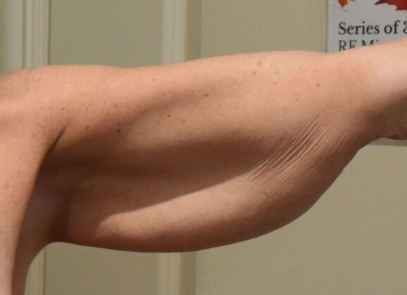 Brachioplasty: Case 26 - Before