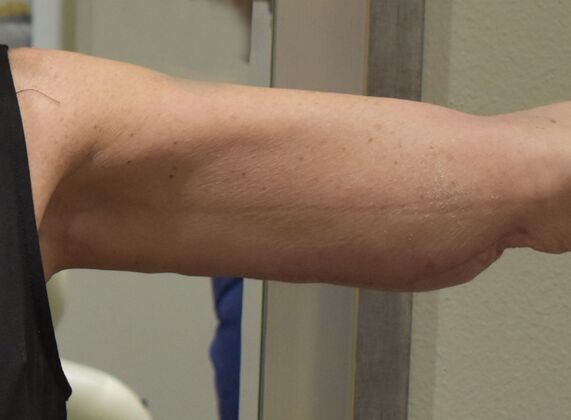 Brachioplasty: Case 26 - After