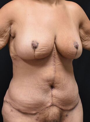 Massive Weight Loss : Case 204 - After