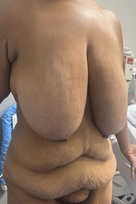 Massive Weight Loss : Case 204 - Before