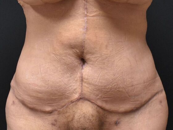 Tummy Tuck (Abdominoplasty) Case 577 - After