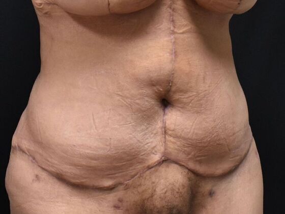 Tummy Tuck (Abdominoplasty): Case 577 - After