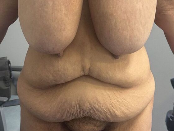 Tummy Tuck (Abdominoplasty) Case 577 - Before