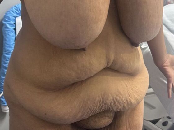 Tummy Tuck (Abdominoplasty): Case 577 - Before