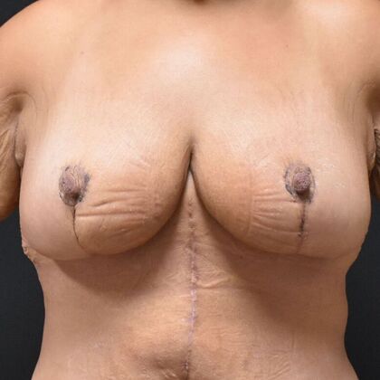 Breast Reduction: Case 209 - After