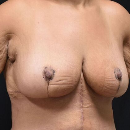 Breast Reduction: Case 209 - After