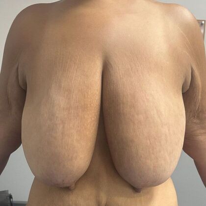 Breast Reduction: Case 209 - Before