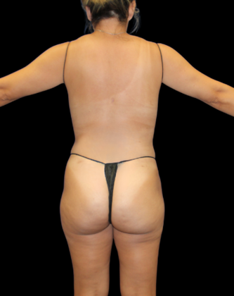 Liposuction: Case 17 - After