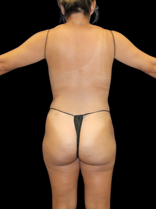 Liposuction: Liposuction 6 - After