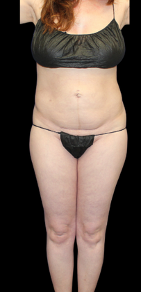 Brazilian Butt Lift: Case 25 - Before