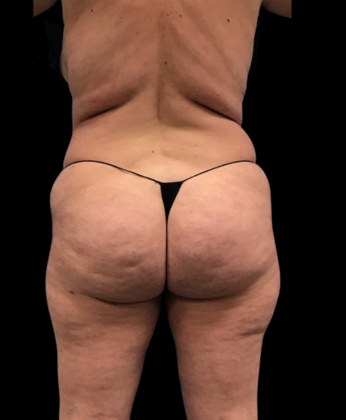 Brazilian Butt Lift Case 26 - Before