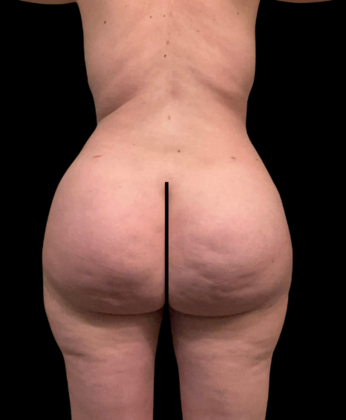 Brazilian Butt Lift Case 26 - After