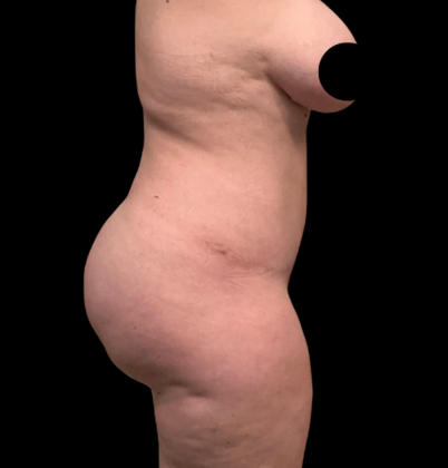 Brazilian Butt Lift: Case 26 - Before