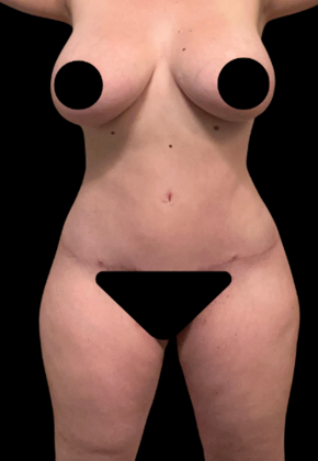 Brazilian Butt Lift: Case 26 - After