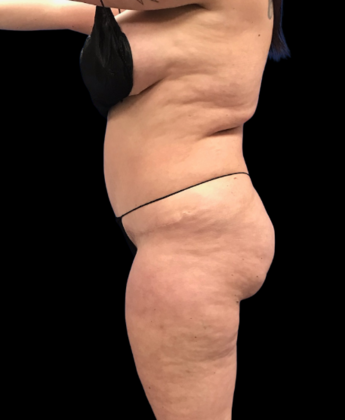 Brazilian Butt Lift: Case 26 - Before