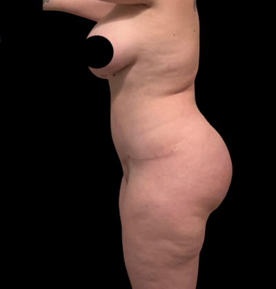 Brazilian Butt Lift: Case 26 - After