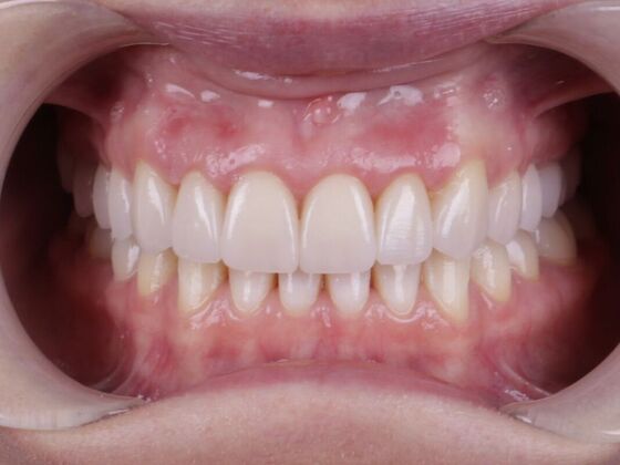 Smile Transformations Case 2 - After