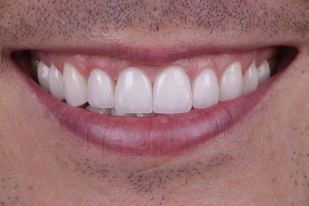 Smile Transformations Case 3 - After