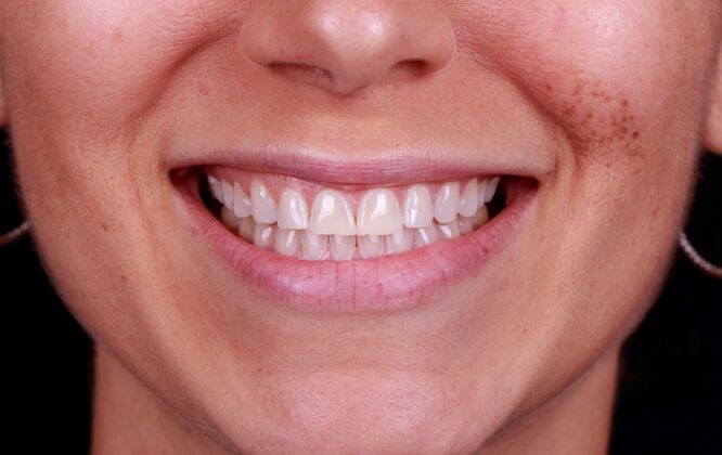 Smile Transformations Case 4 - Before